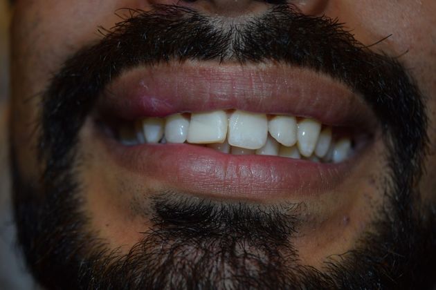 before veneers